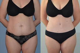 before-and-after-tummy-tuck-in-abu-dhabi