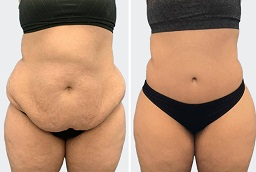 before-and-after-tummy-tuck