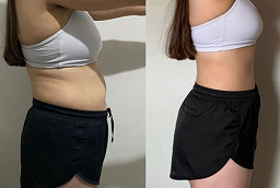 Before and After Non-Invasive Fat Removal