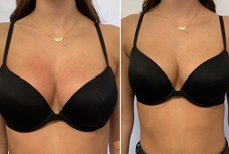 Breast Enlargement Injections After and Before