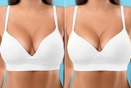 Breast Enlargement Injections 8 Breast Enlargement Injections Before and After