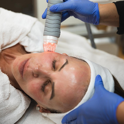 Is RF Micro Needling Effective For Rosacea Skin?