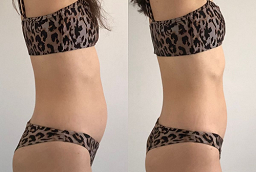 Non-Invasive Fat Removal After and Before