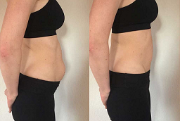 Non-Invasive Fat Removal Before and After
