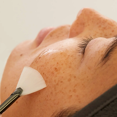 Do Chemical Peels Help with Acne Scars?