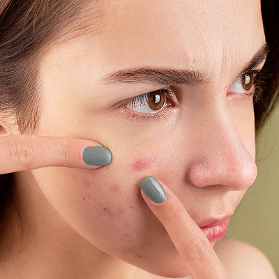 How Effective Is Acne Treatment For Teenage Skin?