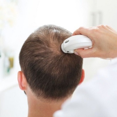 How Is Hair Loss Diagnosed Before Hair Transplant?